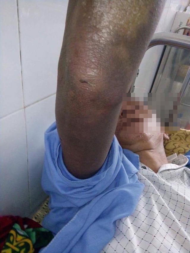 Kinh hoàng bố bị con trai đánh bầm dập, gãy xương sườn, mẻ bánh chè